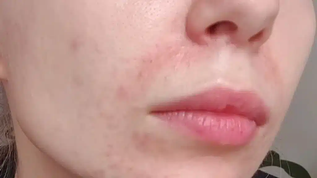 eczema causes, 