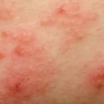 pubic area eczema, genital eczema, penile eczema, eczema on my penis, vulvar eczema, eczema on my privates,