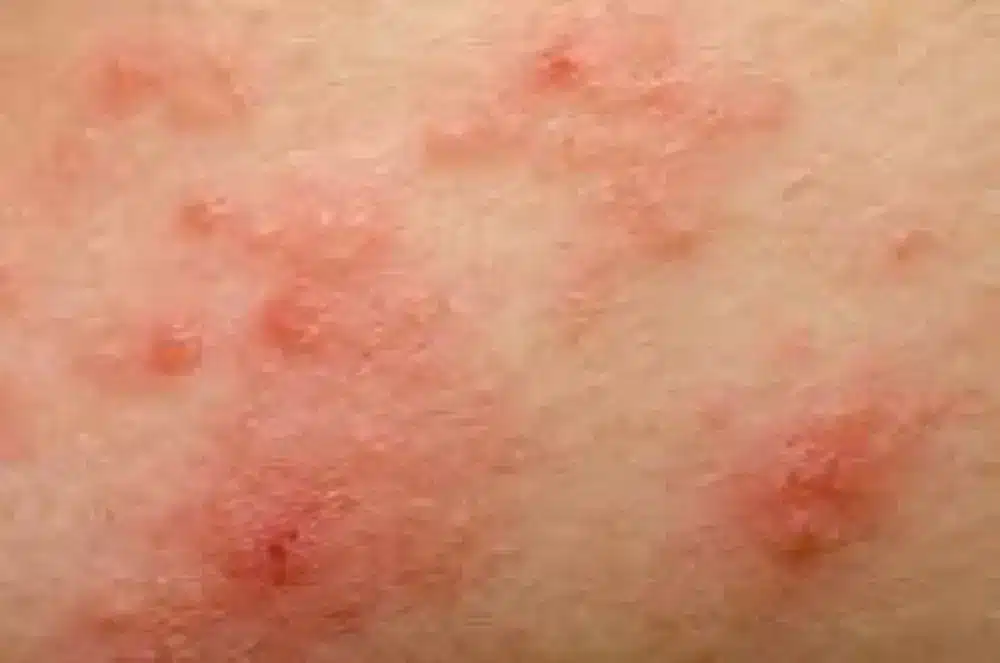 Skin inflammation in the sensitive pubic area