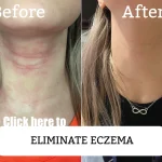 Effect before and after eczema removal