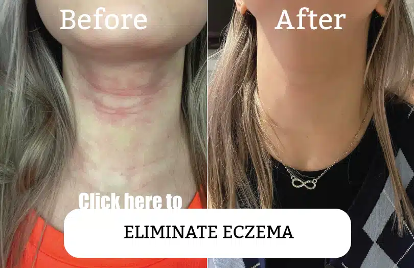 Effect before and after eczema removal