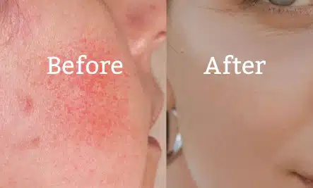 Before and after skincare comparison image
