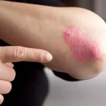 Elbow with eczema