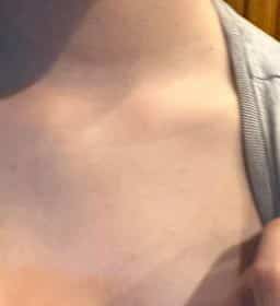 photograph of eczema on lady's chest after