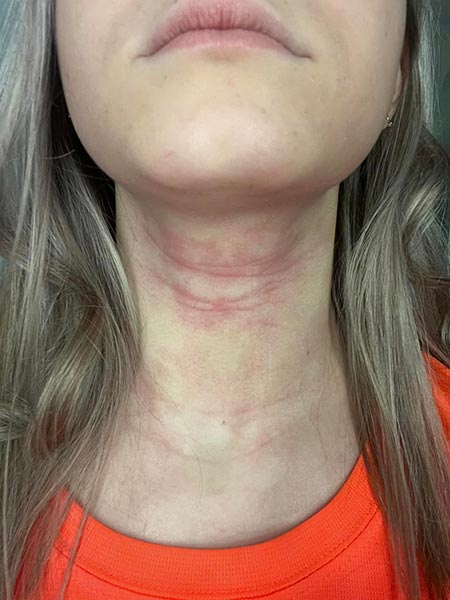 eczema-prone skin before using Atopic Cream