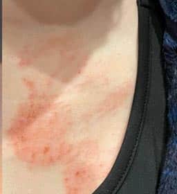 photograph of eczema on lady's chest before