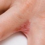 ​psoriasis treatment cream, best psoriasis cream, psoriasis ointment Ireland, natural psoriasis treatment, psoriasis relief cream, Dyshidrotic Eczema hands, for psoriasis cream, plaque psoriasis, (plaque cirrhosis)