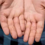 Palms with dyshidrotic eczema