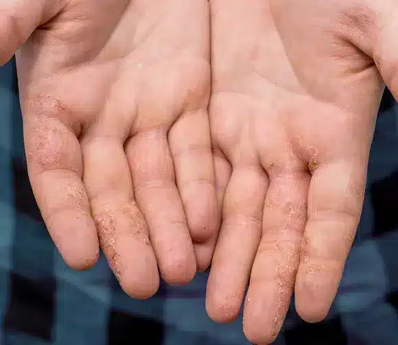 Dyshidrotic Eczema treatment, skin care for dyshidrotic eczema, dyshidrotic eczema natural remedies, best creams for dyshidrotic eczema, dyshidrotic eczema triggers, Natural Alternatives to Steroids for Dyshidrotic Eczema, Natural Alternatives to Steroids for Dyshidrotic Eczema, fingertip eczema