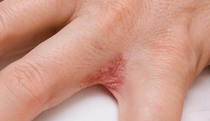 Plaque psoriasis on hand