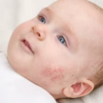 ​baby with eczema on cheek