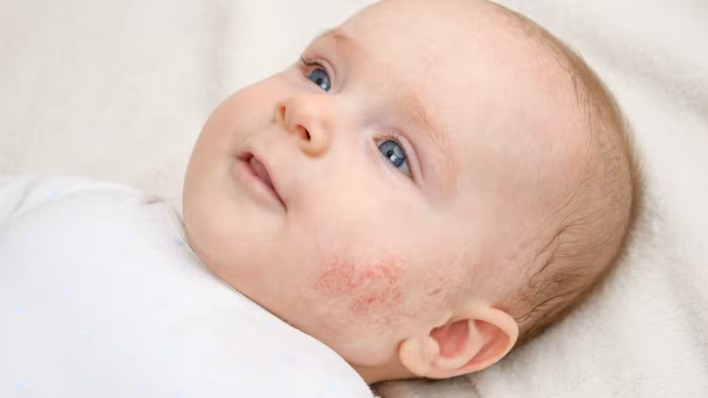 baby with eczema on cheek