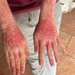 eczema on the hands