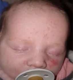 photograph of infant acne before