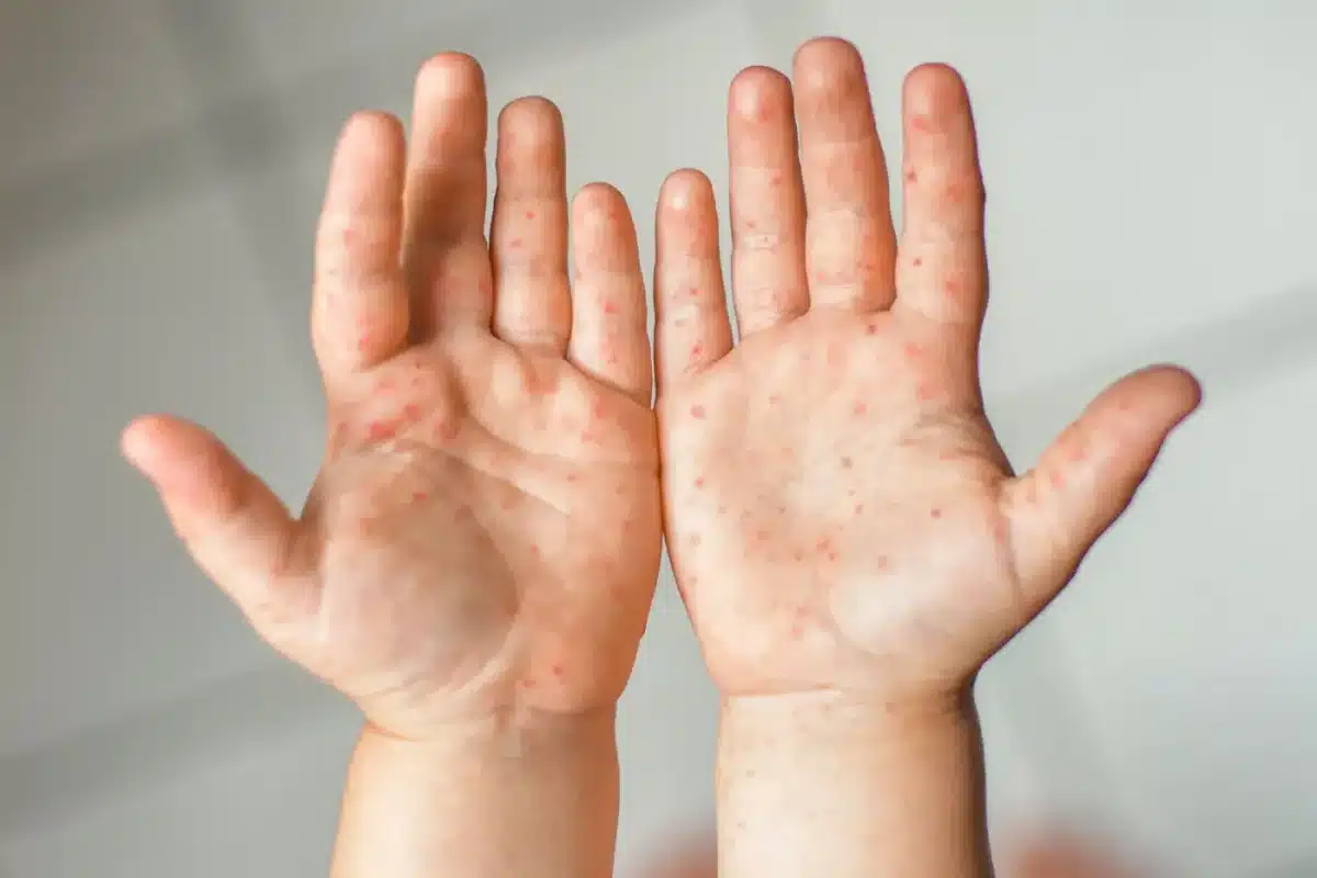 Contact eczema on dry cracked hands – example of irritant dermatitis