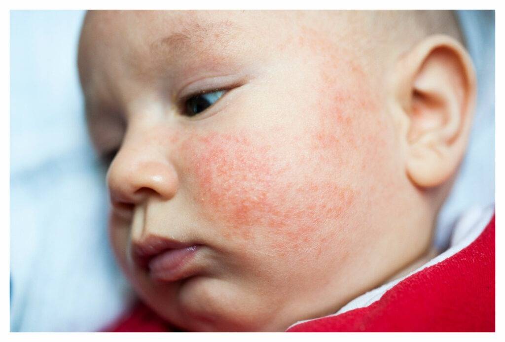 Baby with red, dry eczema patches on the cheeks, a common area for infant eczema.