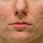 ice pick scars,