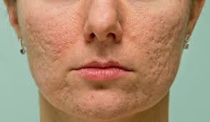 icepick scars,