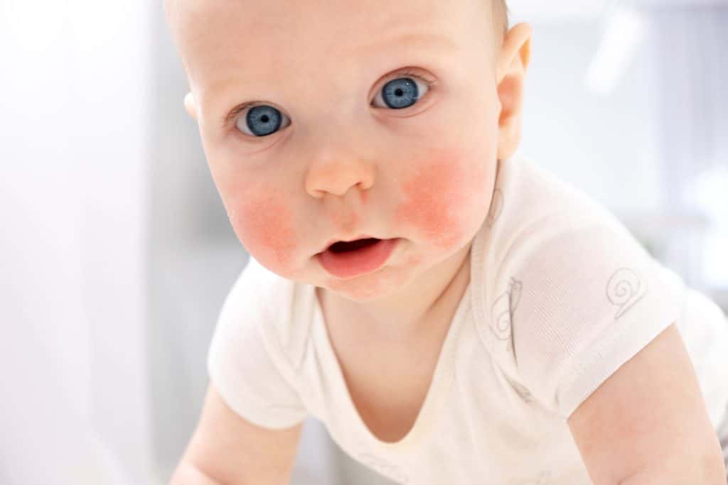 baby with eczema patches on face