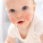 ​Early Signs of Eczema in Babies