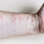 Pink rash on inner side of forearm