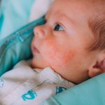 ingant eczema, seborrheic dermatitis face cream, newborn eczema cream,