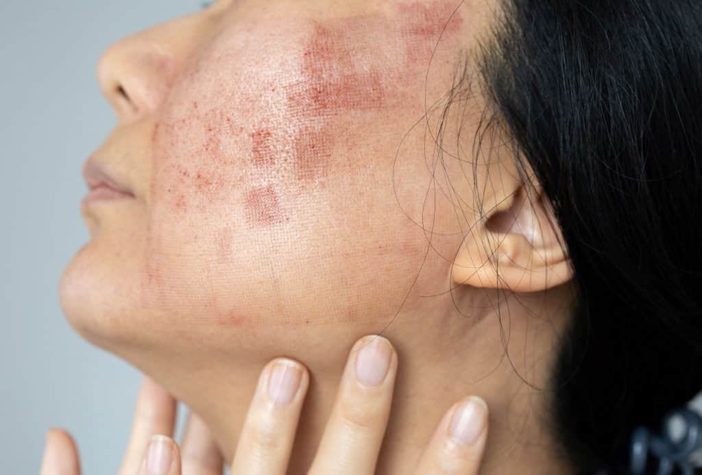 Nummular dermatitis rash close-up