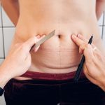 Tummy tuck scar