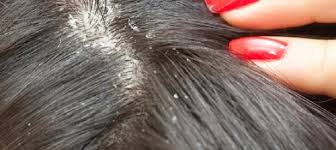 Seborrhoeic psoriasis on scalp showing red patches and flaking skin