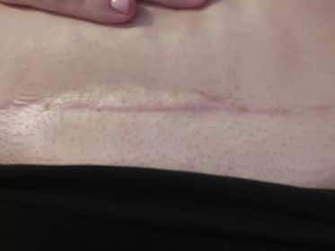 How to Treat Scars on the Face, Best Snail Cream for Scars, how to det rid of scars,