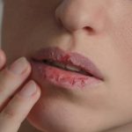remedy for cracked lips, lip balm,dry lips, chapped lips,