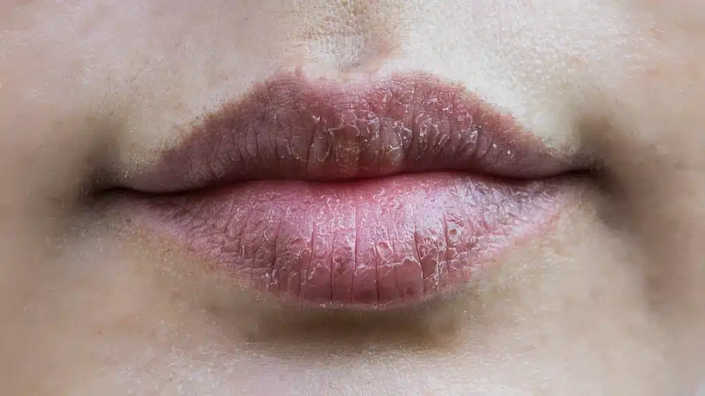 Dry cracked lips