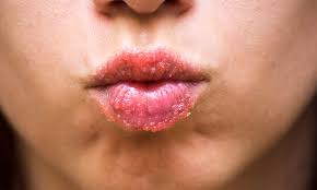 Dry cracked lips