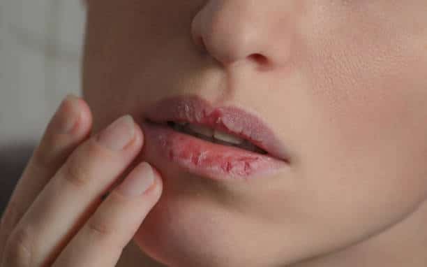 Dry cracked lips