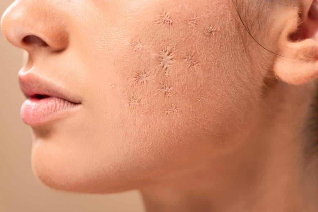 facial scars,