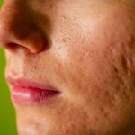 Post-acne, scars and red festering pimples on the face of a woman