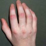 psoriatic psoriasis,