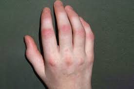 psoriatic psoriasis,