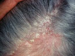 seborrheic dermatitis on the scalp,