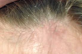 Scalp affected by seborrheic dermatitis before treatment