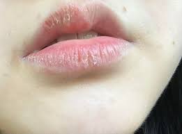 severely chapped lips,