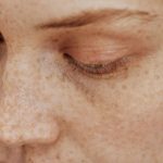 Face damaged by the sun