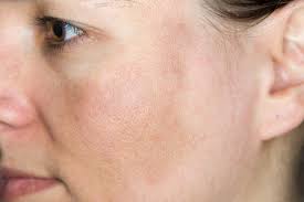 sun damaged skin cream, snail cream for sun damaged skin,