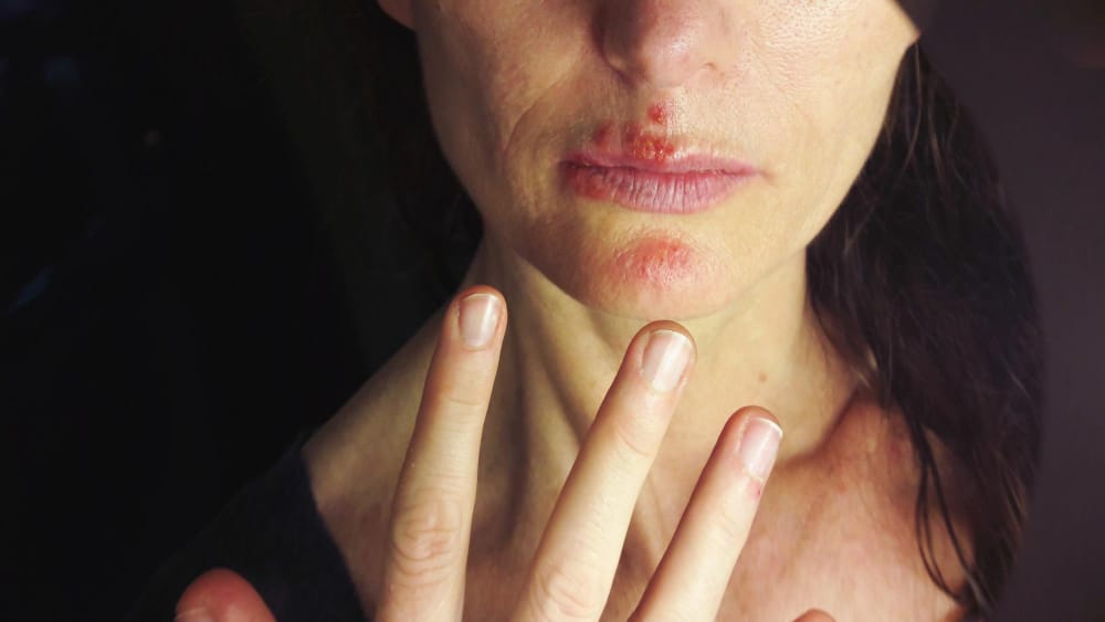 perioral dermatitis, skin rash around mouth, facial rash treatment Ireland, perioral dermatitis causes, gentle skin care for rash, perioral dermatitis cream