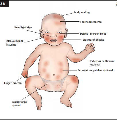 dermatitis in infants, Signs of Eczema in Infants