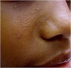 How Seborrheic Dermatitis Affects Dark skin, Seborrheic Dermatitis dark skin