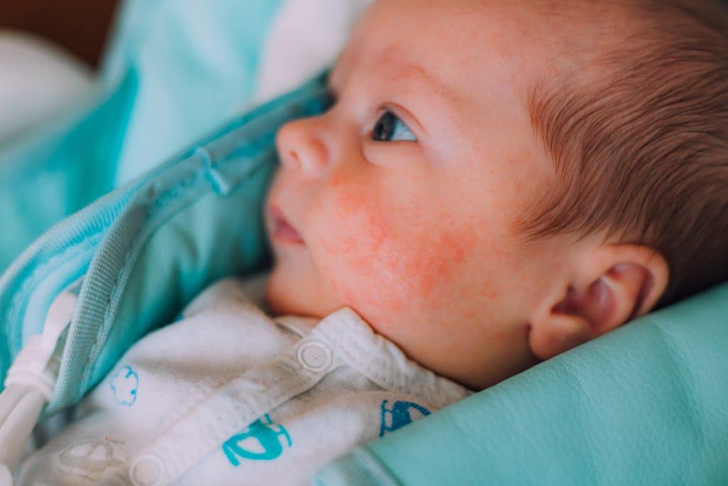 ​infant eczema, baby eczema treatment, eczema creams for infants, infant eczema symptoms, eczema causes in babies, Eczema in Small Babies, Infant perioral dermatitis,