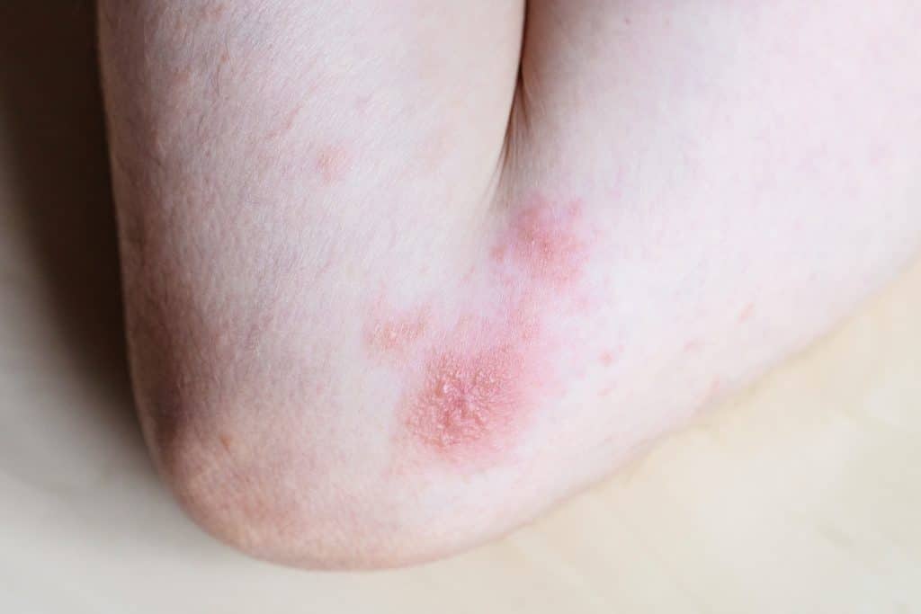 ​drematitis treatment, drematitis cream, drematitis home remedies, drematitis symptoms, drematitis relief, Best Cream for Contact Dermatitis