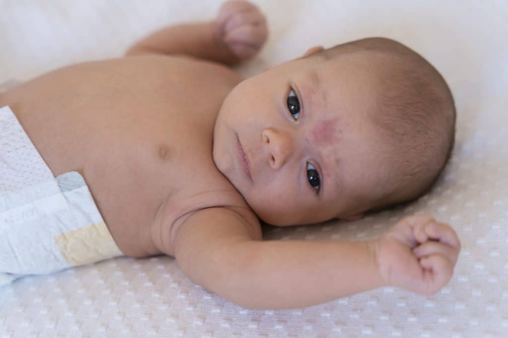 dermatitis in infants, infant eczema cream