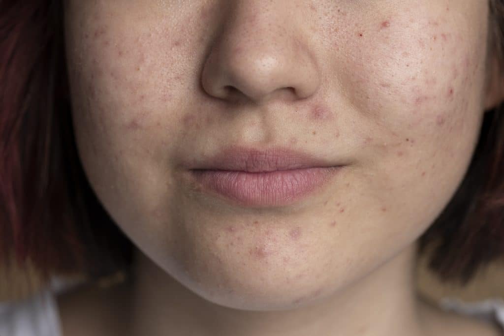is snail mucin good for acne scars,